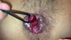 Abspielen Fachwerk und Straße die intramuralen Hämorrhoiden